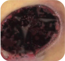 Odleżyny_html_3853a12e