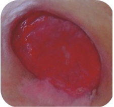 Odleżyny_html_m21582b49