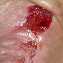 Odleżyny_html_mb71a5da